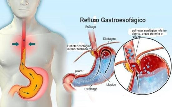 Cirurgião Marcelo Heidrich fala sobre Doença do Refluxo Gastro Esôfago (DRGE)