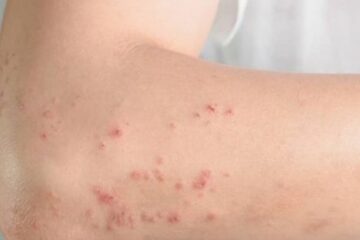 Vinte por cento das crianças e sete por cento dos adultos brasileiros sofrem com dermatite atópica