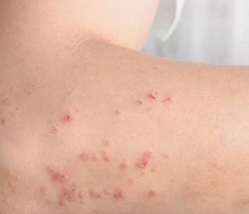 Vinte por cento das crianças e sete por cento dos adultos brasileiros sofrem com dermatite atópica