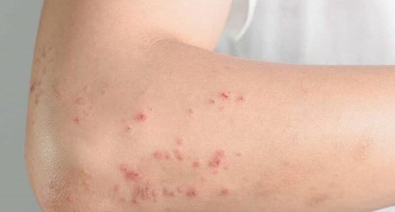 Vinte por cento das crianças e sete por cento dos adultos brasileiros sofrem com dermatite atópica